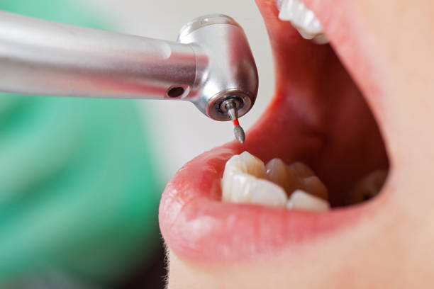 Best Emergency Dentist for Lost Fillings or Crowns in Sylvania, AL